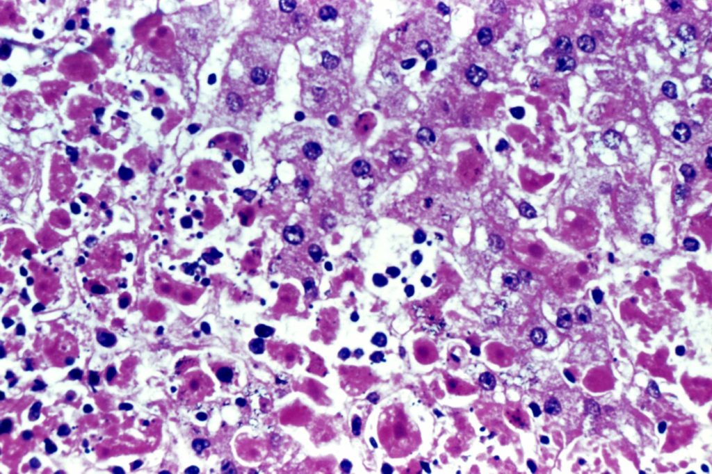Micrograph of human liver tissue infected with the ebola virus