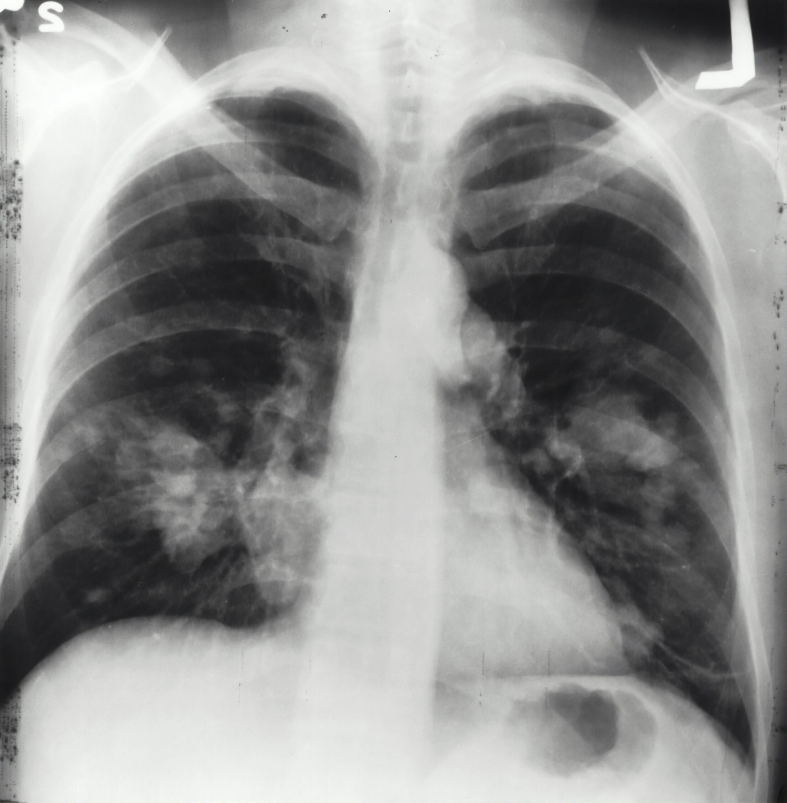 lung cancer
