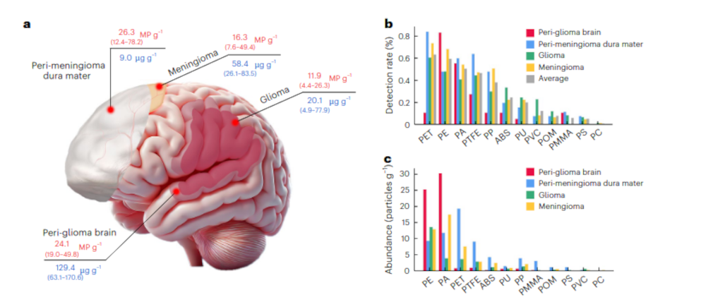 This diagram from the Nature Health study maps the presence of micro- and nanoplastics (MNPs) in the diseased human brain, detailing median concentrations